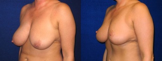 Left 3/4 View - Breast Reduction After Pregnancy