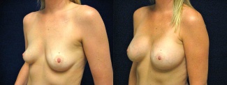 Left 3/4 View - Breast Augmentation - Silicone Implants