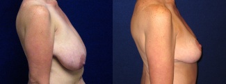 Right Profile View - Breast Lift Reduction