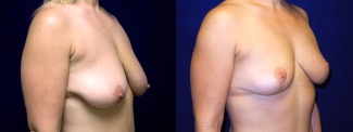 Right 3/4  View - Breast Lift After Weight Loss