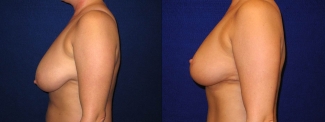 Left Profile View - Breast Reduction After Pregnancy