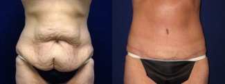 Frontal View - Tummy Tuck