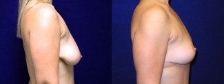 Right Profile  View - Breast Lift After Weight Loss