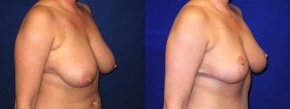 Right 3/4 View - Breast Reduction After Pregnancy