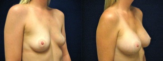 Right 3/4 View - Breast Augmentation - Silicone Implants