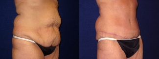 Right 3/4 View - Tummy Tuck