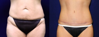 Frontal  View - Tummy Tuck After Weight Loss