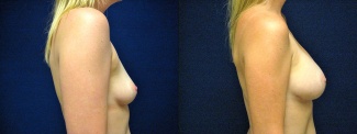 Right Profile View - Breast Augmentation - Silicone Implants