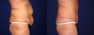 Right Profile View - Tummy Tuck