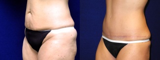 Left 3/4 View - Tummy Tuck After Weight Loss