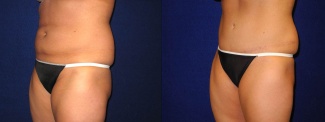 Left 3/4 View - Tummy Tuck After Pregnancy