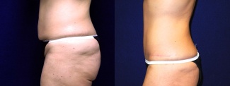 Left Profile View - Tummy Tuck After Weight Loss