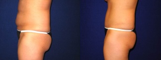 Left Profile View - Tummy Tuck After Pregnancy