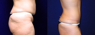 Right Profile View - Tummy Tuck After Weight Loss