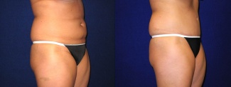 Right 3/4 View - Tummy Tuck After Pregnancy