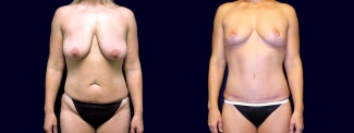 Frontal View - Breast Lift & Tummy Tuck After Weight Loss