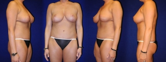 Full View - Breast Reduction and Tummy Tuck After Pregnancy