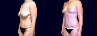 Left 3/4 View - Breast Lift & Tummy Tuck After Weight Loss