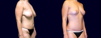 Right 3/4 View - Breast Lift & Tummy Tuck After Weight Loss