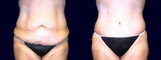 Frontal View - Extended Abdominoplasty
