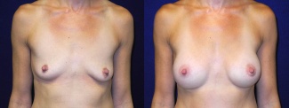 Frontal View - Breast Augmentation After Pregnancy