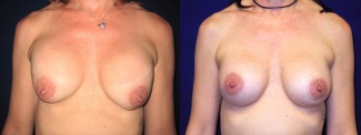 Frontal View - Breast Implant Revision - Silicone Implants