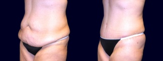 Left 3/4 View - Extended Abdominoplasty