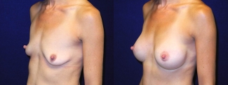 Left 3/4 View - Breast Augmentation After Pregnancy