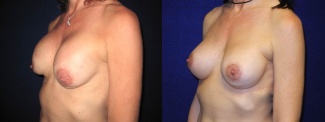 Left 3/4 View - Breast Implant Revision - Silicone Implants