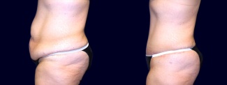 Left Profile View - Extended Abdominoplasty