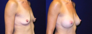 Right 3/4 View - Breast Augmentation After Pregnancy