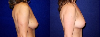 Right Profile View - Breast Lift After Pregnancy