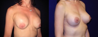 Right 3/4 View - Breast Implant Revision - Silicone Implants