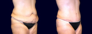 Right 3/4 View - Extended Abdominoplasty