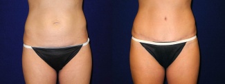 Frontal View - Tummy Tuck After Pregnancy