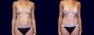 Frontal View - Breast Augmentation and Tummy Tuck 