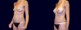 Left 3/4 View - Breast Augmentation and Tummy Tuck 