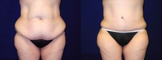 Frontal View - Circumferential Tummy Tuck