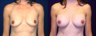 Frontal View - Breast Augmentation After Pregnancy