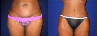 Frontal View - Tummy Tuck After Pregnancy