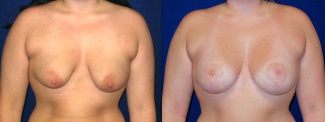 Frontal View - Breast Augmentation with Lift - Silicone Implants