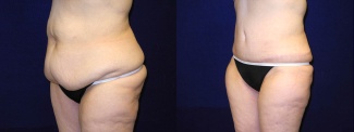 Left 3/4 View - Circumferential Tummy Tuck