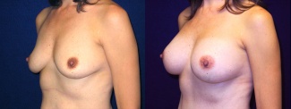 Left 3/4 View - Breast Augmentation After Pregnancy