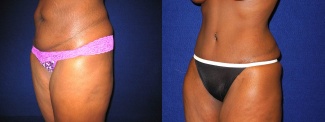 Left 3/4 View - Tummy Tuck After Pregnancy