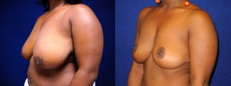 Left 3/4 View - Breast Reduction Lift