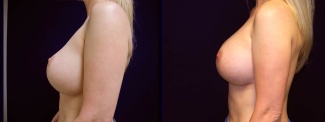 Left Profile View - Breast Implant Revision - Silicone Implants