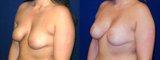 Left 3/4 View - Breast Augmentation with Lift - Silicone Implants