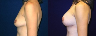 Left Profile View - Breast Augmentation After Pregnancy