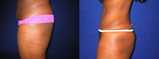 Left Profile View - Tummy Tuck After Pregnancy