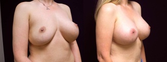 Right 3/4 View - Breast Implant Revision - Silicone Implants